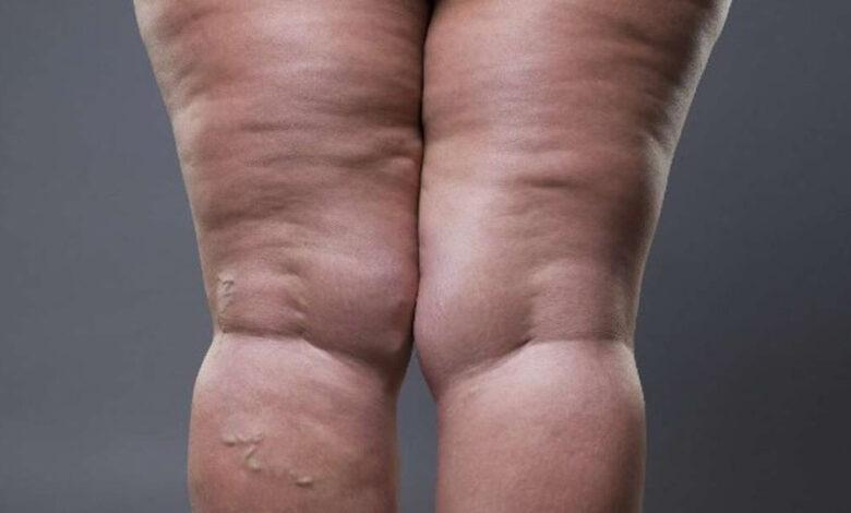 LIPEDEMA: SAIBA COMO TRATAR E IDENTIFICAR DOENÇA QUE ATINGE MAIS DE 11% DAS MULHERES